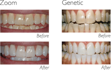 Coloración dental - Blanqueamiento dental