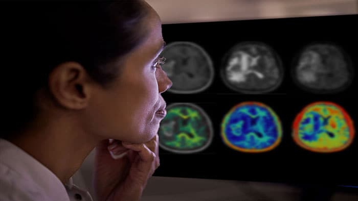 Philips se asocia con Synthetic MRI para ofrecer imágenes cerebrales cuantitativas basadas en inteligencia artificial para mejorar la atención neurológica de los pacientes