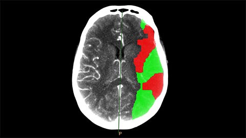 CT Brain Perfusion