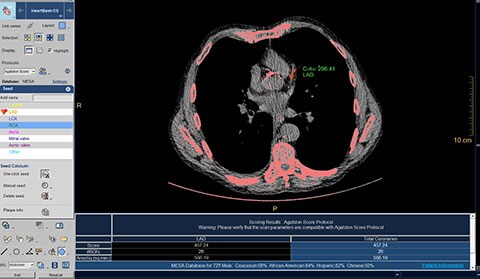 CT Calcium Scoring