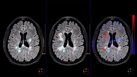 MR Longitudinal Brain Imaging (LoBI)