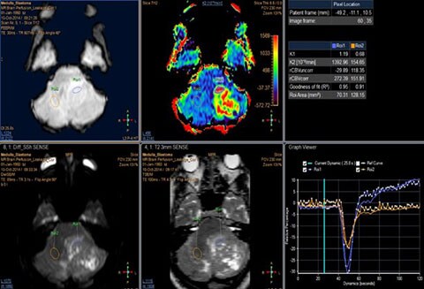 MR T2* (Neuro) Perfusion