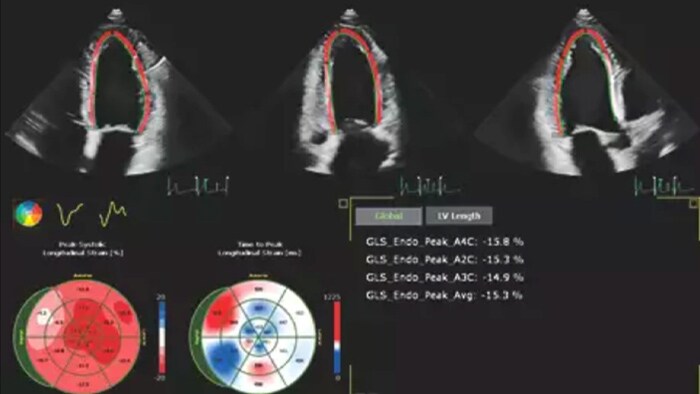 Imagen que muestra los resultados de la automatización para una cuantificación cardiaca sólida y reproducible tanto en 2D como en 3D