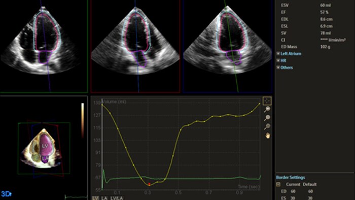 Imagen que muestra la cuantificación a través de Dynamic HeartModel de Philips
