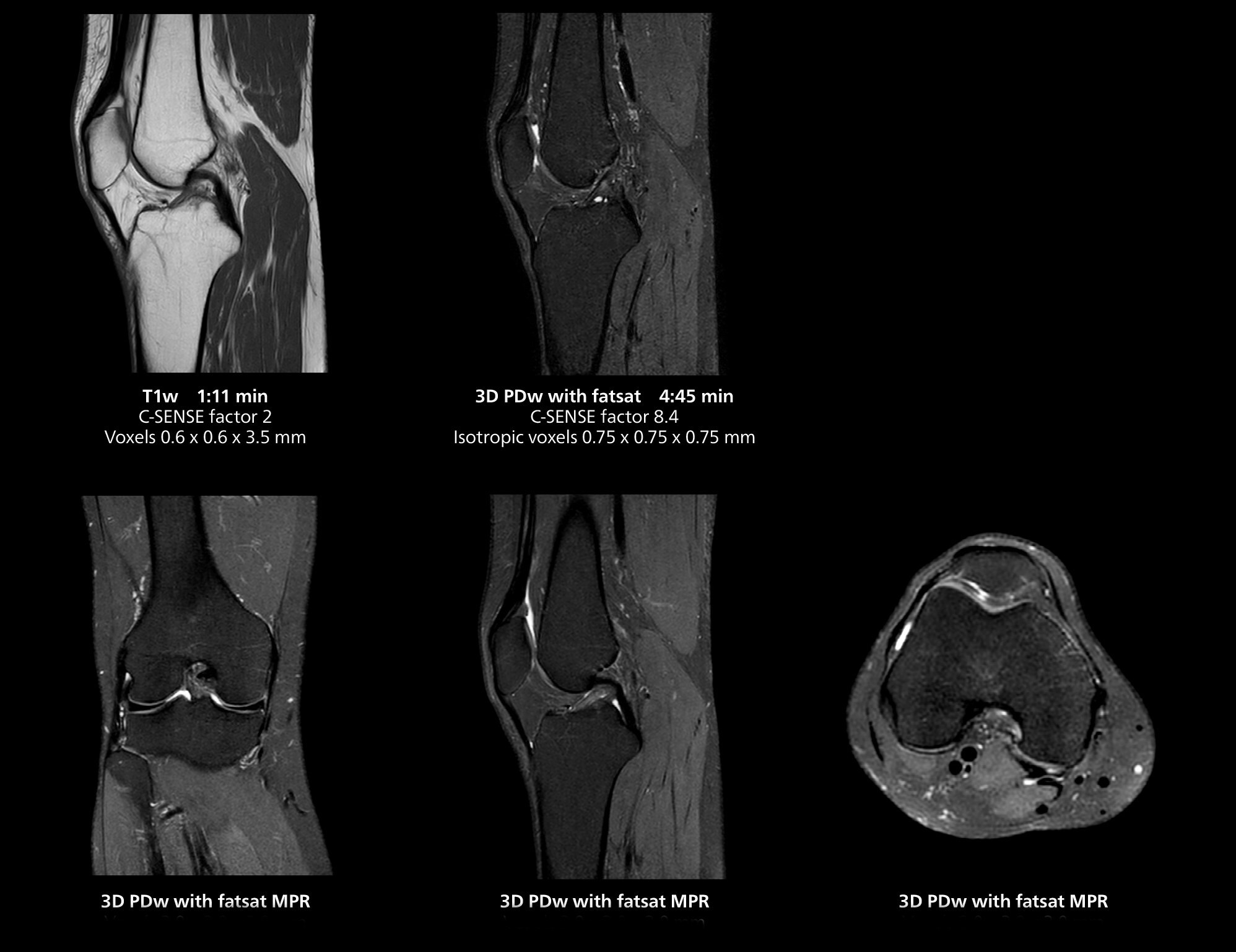 RM de rodilla