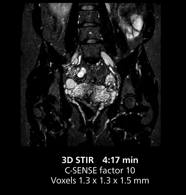 RM de pelvis tres