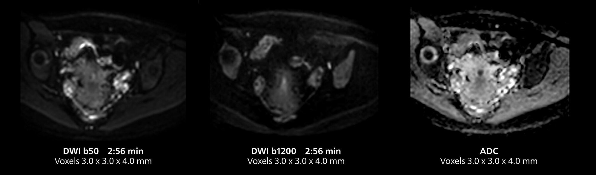 RM de pelvis