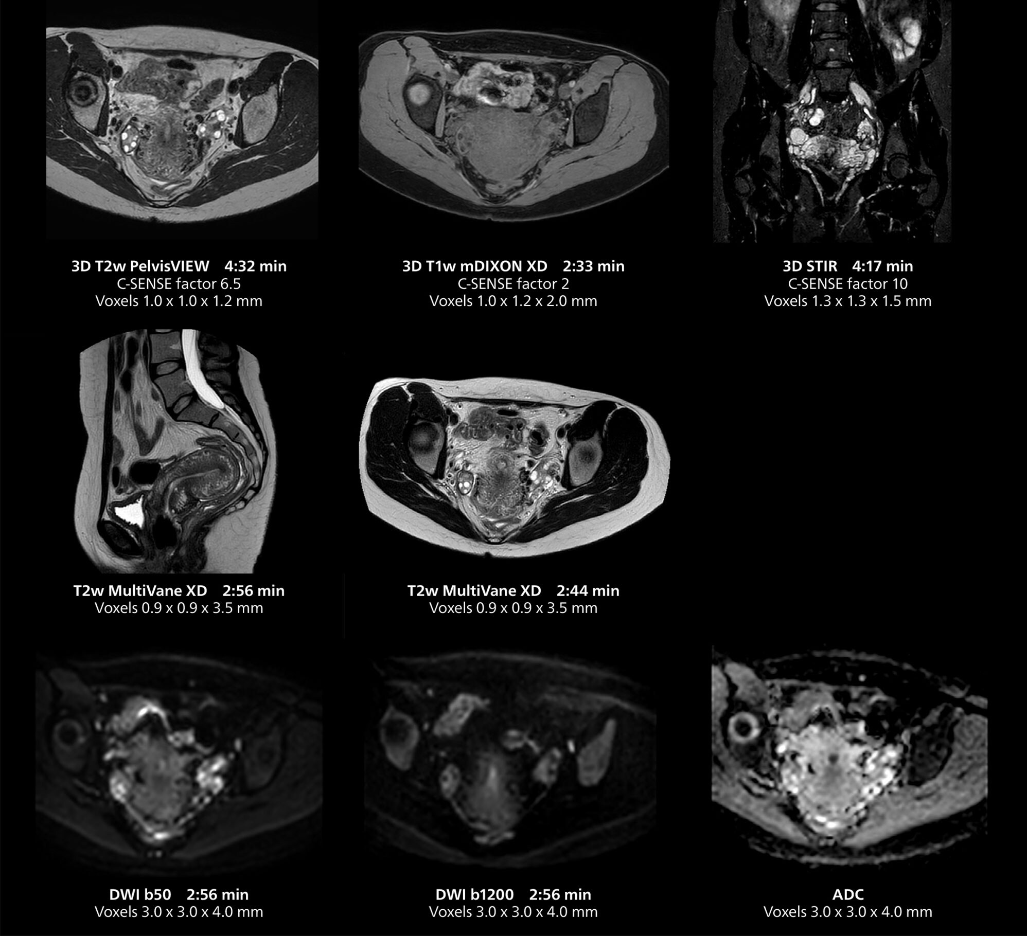 RM de pelvis femenina