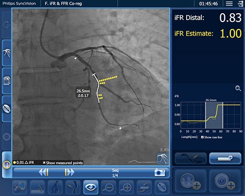 Corregistro de iFR