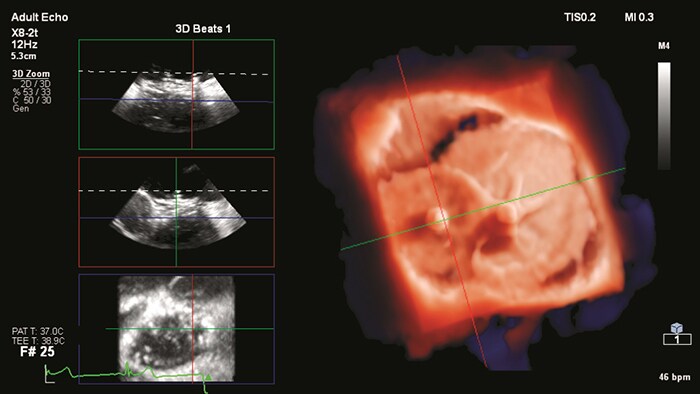 Ultrasonido intravascular (IVUS)