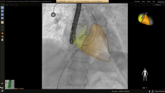 Segmentación cardiaca de EchoNavigator