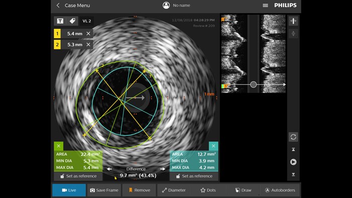 Ultrasonido intravascular (IVUS)