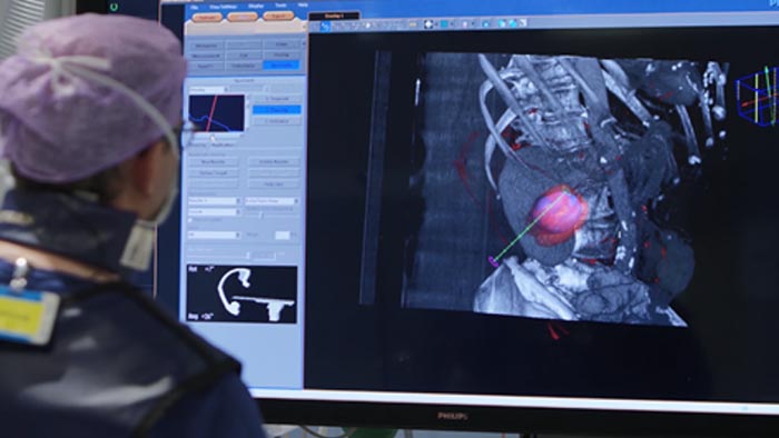 Biopsia y ablación tumorales