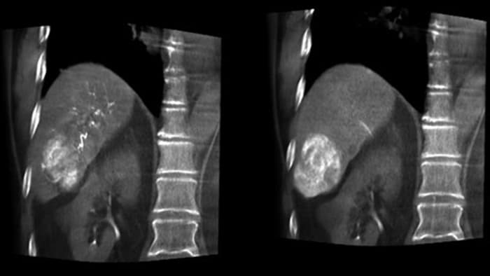 Visualización óptima de arterias y tumores con CBCT Dual