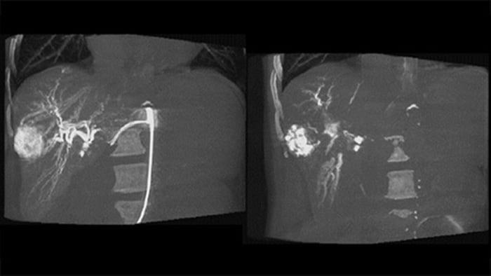 Imágenes 3D posteriores a la embolización con CBCT