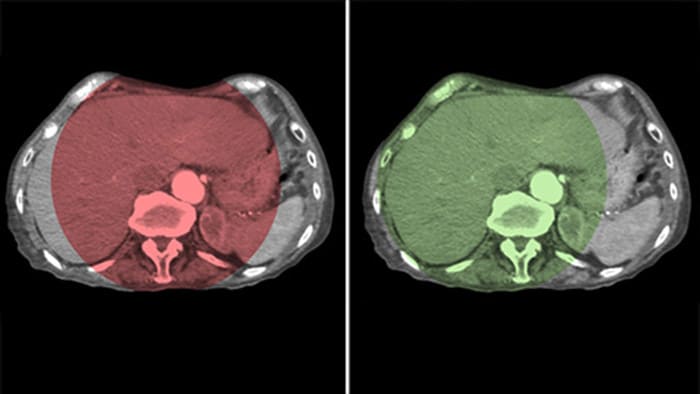 Cobertura completa del hígado con CBCT Open