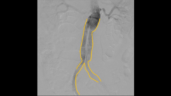 Herramienta de creación de contornos para las bifurcaciones o las ramas laterales