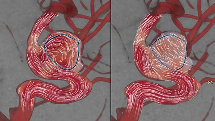 Flujo de aneurisma posterior al tratamiento