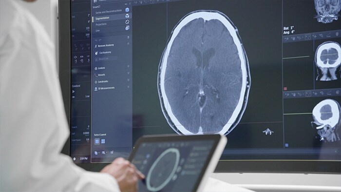 Tratamiento de accidentes cerebrovasculares isquémicos