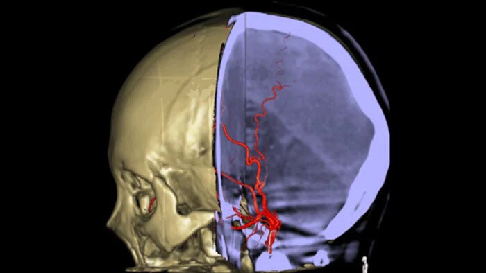 Navegación 3D precisa con SmartCT Roadmap