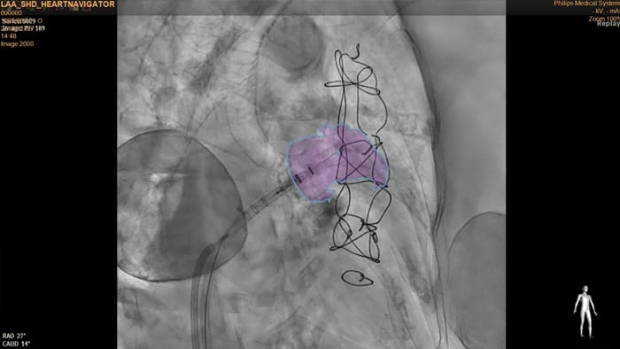 Planificaci&oacute;n de TC de HeartNavigator