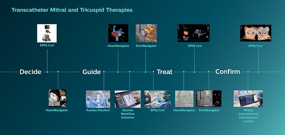 Tratamientos de la válvula mitral y tricúspide con transcatéter