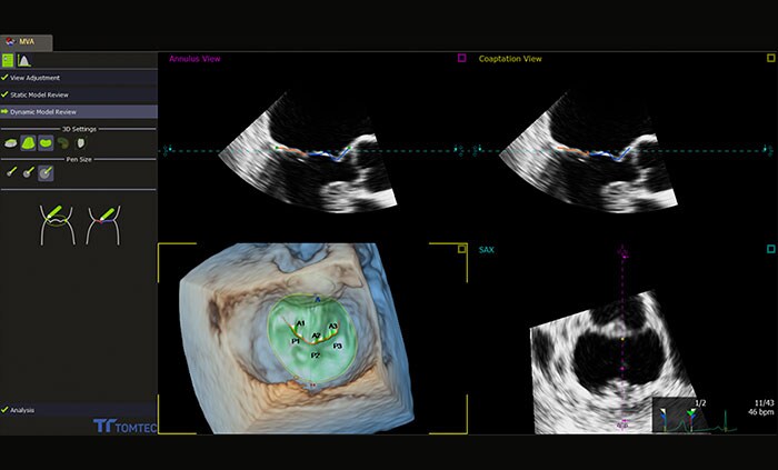 4D Mitral Valve Assessment (MVA)