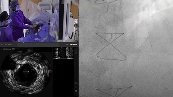 Primer caso de ICP compleja en seres humanos con OmniWire: el primer cable guía de presión de núcleo sólido del mundo. Dr. J. Singh