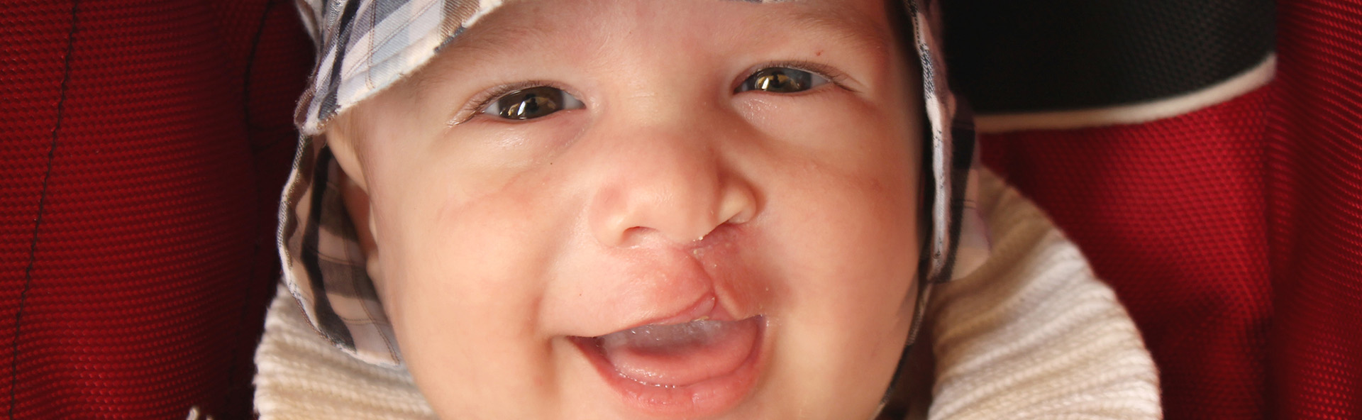 Alimentación del bebé después de la reparación del labio leporino