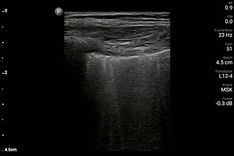 Lung image of the right chest