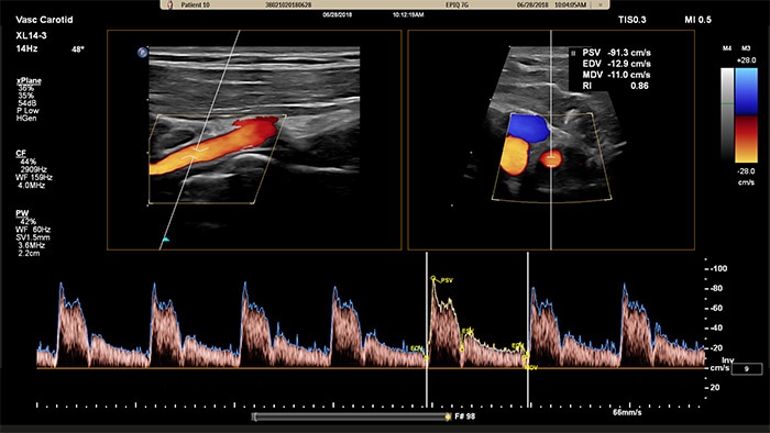 Ejemplo de una imagen recuperada con ecografía vascular Doppler xPlane de Philips