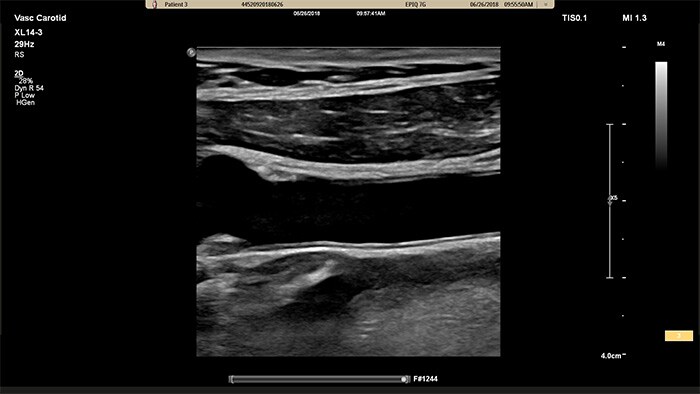 Ejemplo de una imagen recuperada con el transductor de array lineal XL14-3 xMATRIX de Philips