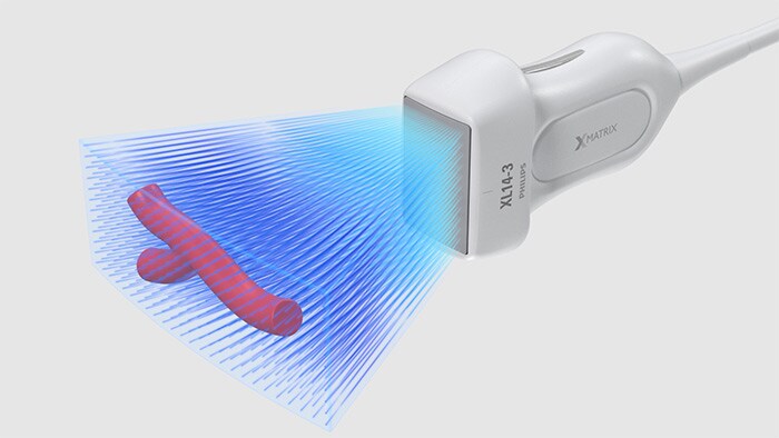 Transductor de array lineal XL14-3 xMATRIX para evaluaciones vasculares de Philips con capacidades 3D/4D de fácil uso