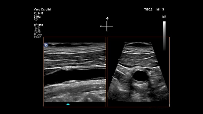 Ejemplo de una imagen recuperada con la ecografía vascular Xplane Imaging de Philips