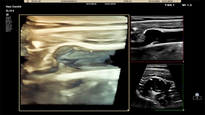 Imagen recuperada con las sencillas funciones 3D/4D del transductor de array lineal XL14-3 xMATRIX de Philips