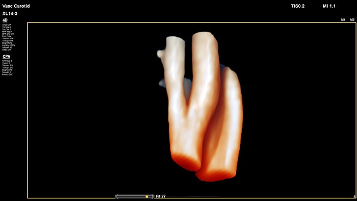 Ejemplo de una imagen de modelado de vasos 3D recuperada con el transductor de array lineal XL14-3 xMATRIX de Philips