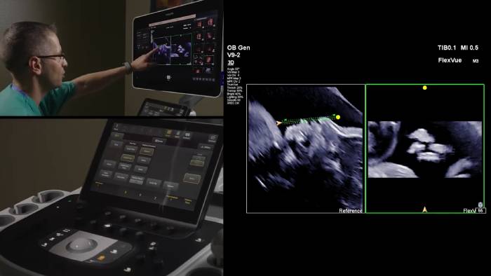 Demostración del transductor V9-2 para ultrasonidos 3D de Philips