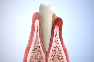 Periodontitis