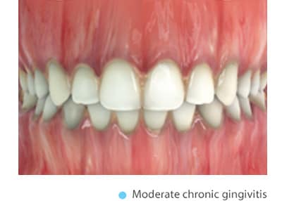 gingivitis