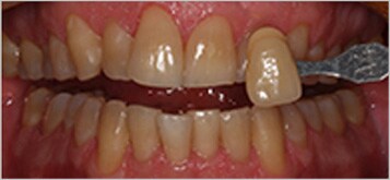 Blanqueamiento dental profesional - Despues