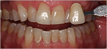 Blanqueamiento dental profesional - Antes