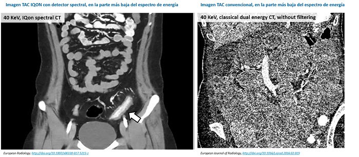 IQON_CT_PHILIPS_DETECTOR_ESPECTRAL_RADIOLOGIA