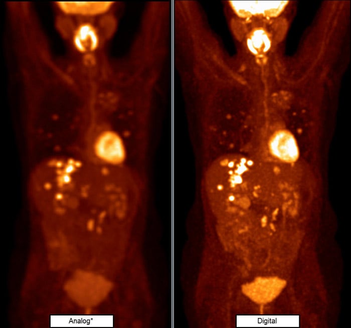 VEREOS_PET_DIGITAL_PHILIPS_ONCOLOGIA