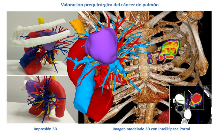 PHILIPS_INTELLISPACE_PORTAL_3D_POSTPROCESADO