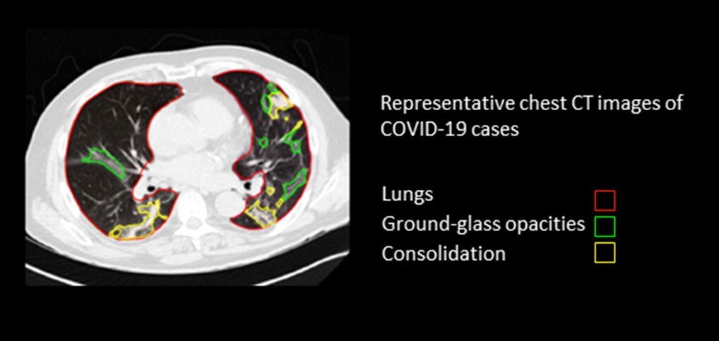 Lung CT