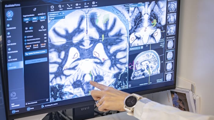Imagen adquirida por RM Philips para el procedimiento MRgFUS -  