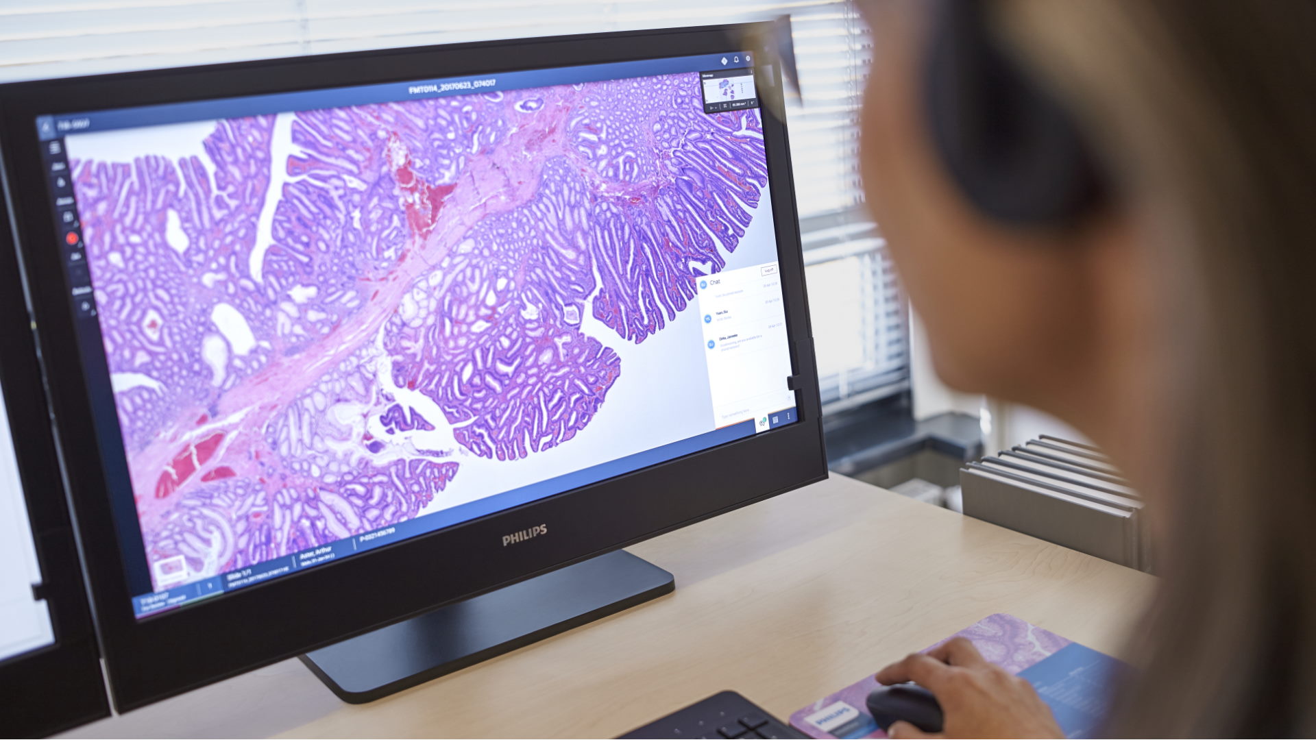 La Unidad Intercentros de Anatomía Patológica de Granada valida e integra en su flujo de trabajo 100% digital, el primer algoritmo para el diagnóstico de Helicobacter pylori