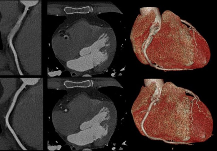 Download image (.jpg) Spectral CT 7500 Motion in Right Coronary Artery Comparison (Se abre en una nueva ventana)