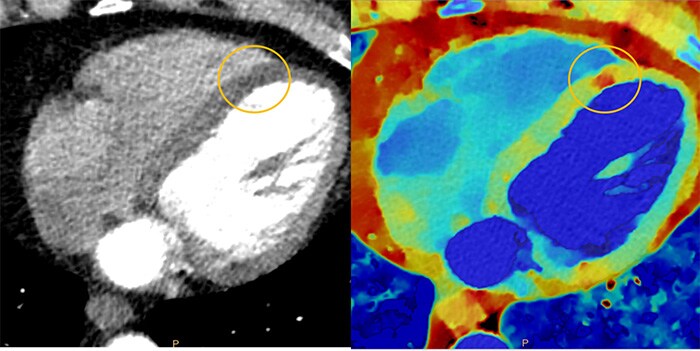 Download image (.jpg) Spectral CT 7500 Myocardial Perfusion Comparison (Se abre en una nueva ventana)