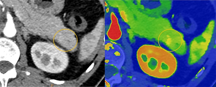 Download image (.jpg) Spectral CT 7500 Pancreatic Lesion Comparison (Se abre en una nueva ventana)